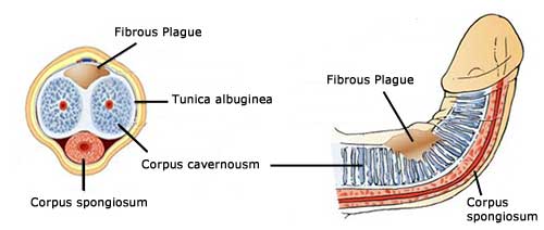 bpc 157 peyronie's disease Peyronies Treatment in Atlanta Peyronie's Disease: Causes, Symptoms, and