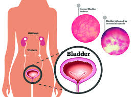 cystitis