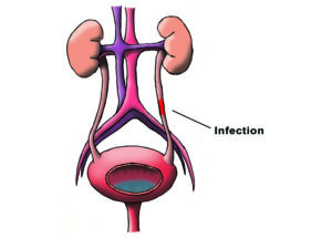 urinary-tract-infection-nyc-urology-specialists-01