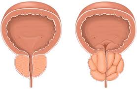 urologist-for-enlarged-prostate-image-01