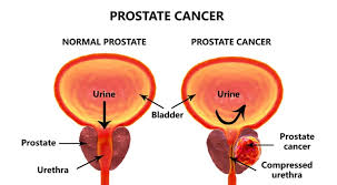 urologist-for-prostate-cancer-specialist-nyc-01