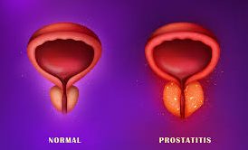 Causes Symptoms And Treatment Of Prostatitis Top Urologist Nyc