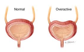 diagram-overactive-bladder-info-specialists-02