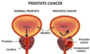 future-prostate-cancer-treatment-outlook-01