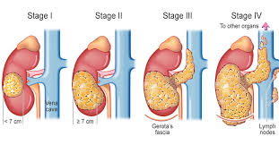 kidney-cancer-stages-info-02