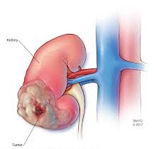 kidney-cancer-treatment-urologists-nyc-01