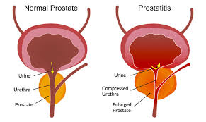 prostatitis symptoms come and go