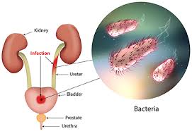 urinary-tract-infections-uti-urologist-nyc-01