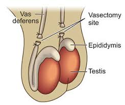 vasectomy-procedure-info-urology-nyc-03
