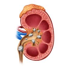 Kidney Pain or Renal Colic - Causes and Treatment - Best Urologist in Manhattan - Treatment of Urological Pain Syndromes
