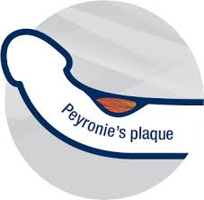 peyronies-penis-info-urologist-specialists-nyc-02