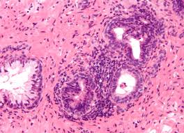 Bacteria cause of Prostatitis