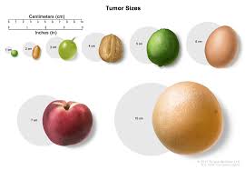 Testicular Cancer Urologist - Treatment Info