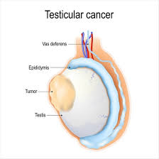 Urologist for Testicular Cancer NYC