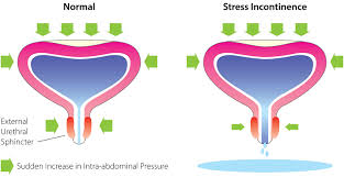 Urinary Incontinence: Men vs. Women - Top Urologist NYC