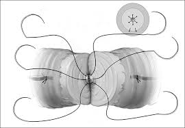 vasectomy-reversal-info-top-urologists-nyc-02