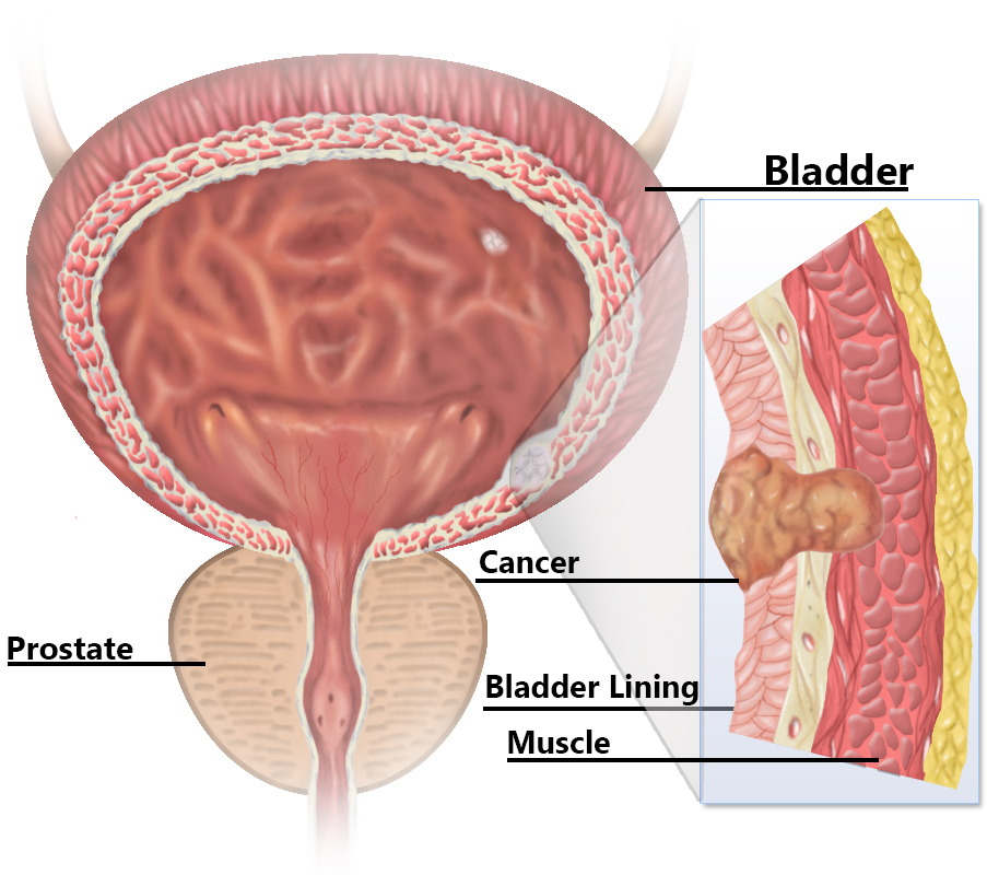 Bladder Cancer & Urology