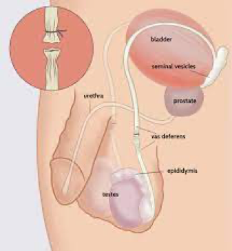 All About Vasectomies