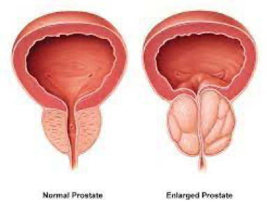 Symptoms of BPH