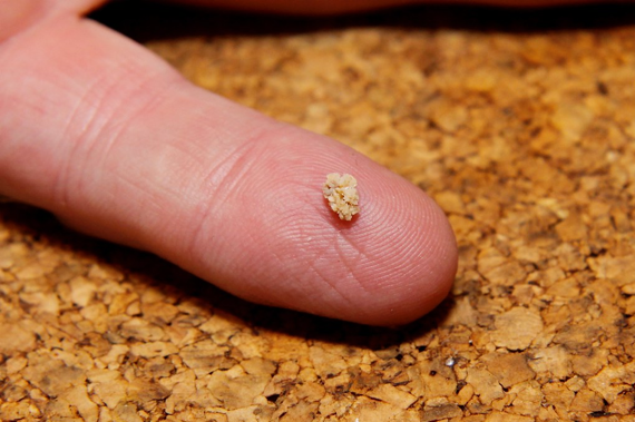 Kidney Stones and Removal