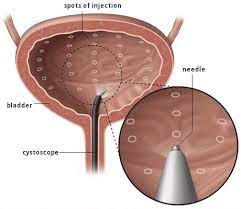 Overactive Bladder Botox Injections | Urge Incontinence Urologist