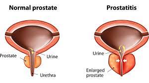 Best urologist Prostatitis NYC
