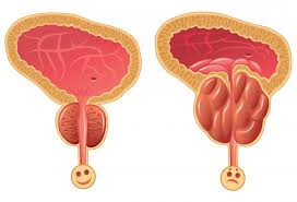 Diagram of bladder & prostate with BPH