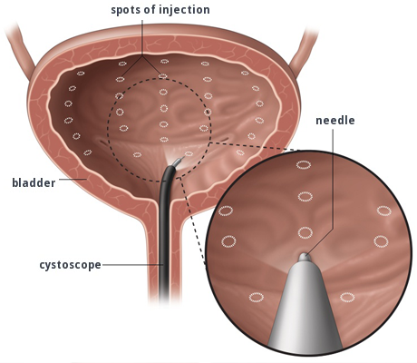 bladder-botox-diagram