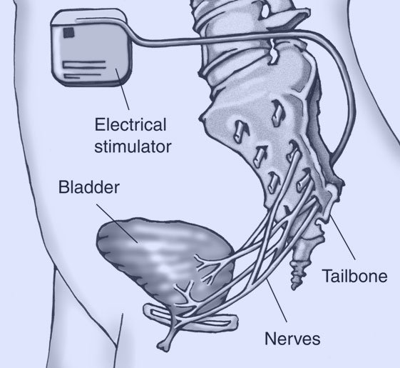 Sacral-Neuromodulation-urologist-nyc-bladder-bowel