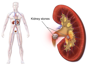 Top Kidney Stone Treatment NYC