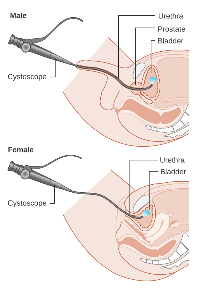 What to Expect During a Cystoscopy Procedure male and female b